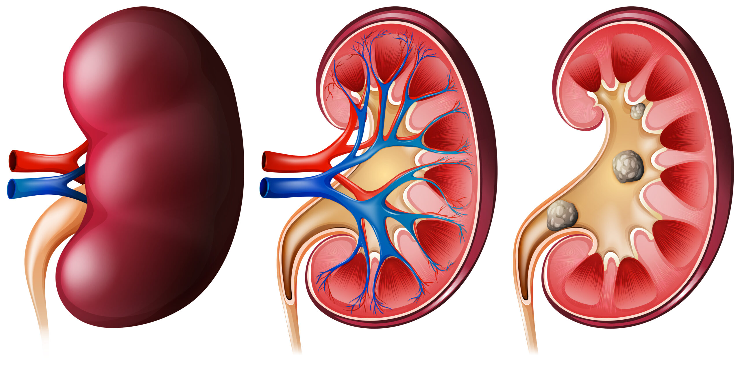 Ilustração de Cálculo Renal