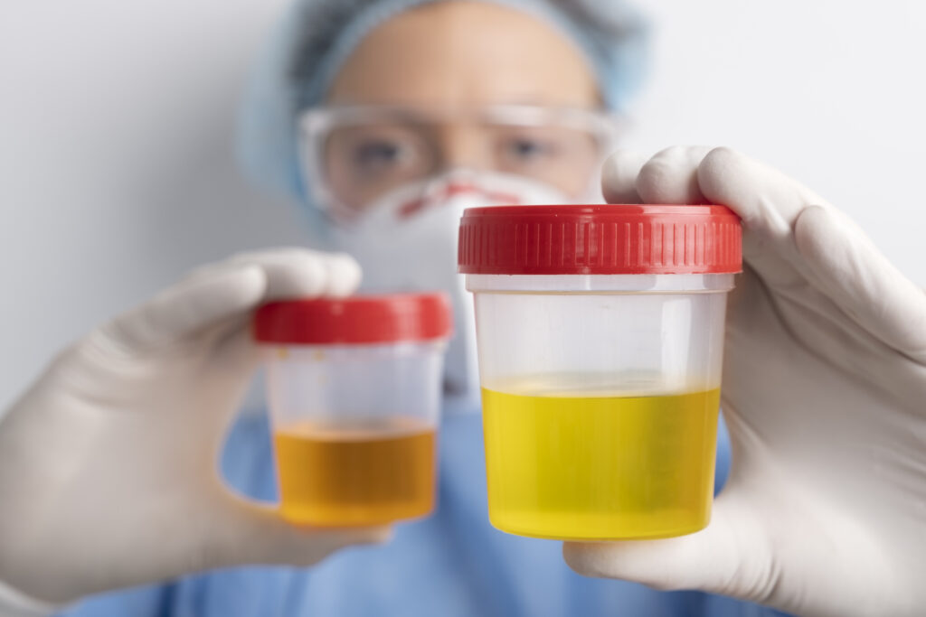 Profissional da saúde segurando frasco com amostra de urina para análise de 24h